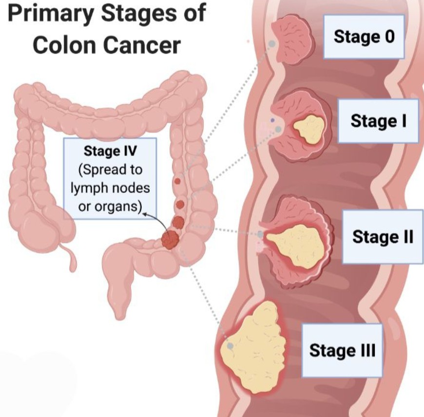 COLON CANCER — THE SILENT KILLER IN YOUR GUT